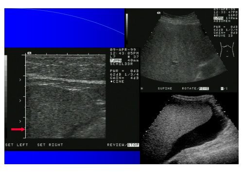 Sonographie bei Lebererkrankungen