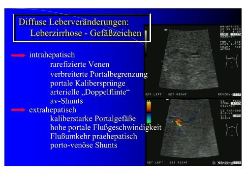 Sonographie bei Lebererkrankungen