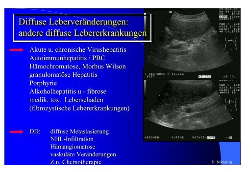 Sonographie bei Lebererkrankungen