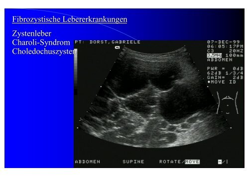 Sonographie bei Lebererkrankungen