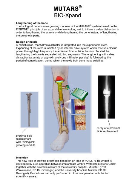 Mutars growing prostheses - Canmed Ortopedi Medikal