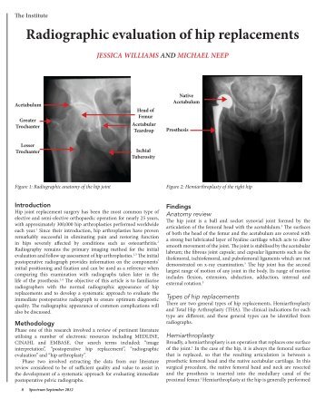 Radiographic evaluation of hip replacements - Minnis Journals