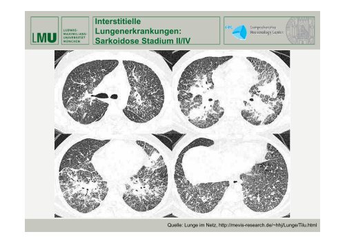 Expertenforum „Lungenfibrose“ - Lungeninformationsdienst