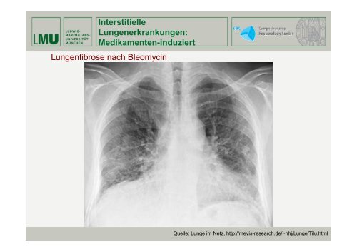 Expertenforum „Lungenfibrose“ - Lungeninformationsdienst