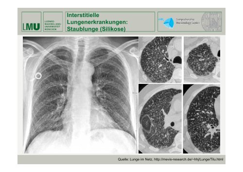 Expertenforum „Lungenfibrose“ - Lungeninformationsdienst