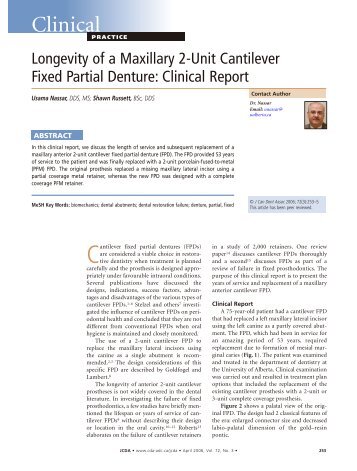 Longevity of a Maxillary 2-Unit Cantilever Fixed - Canadian Dental ...