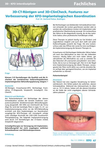 3D Implantat-Planung - Invisalign