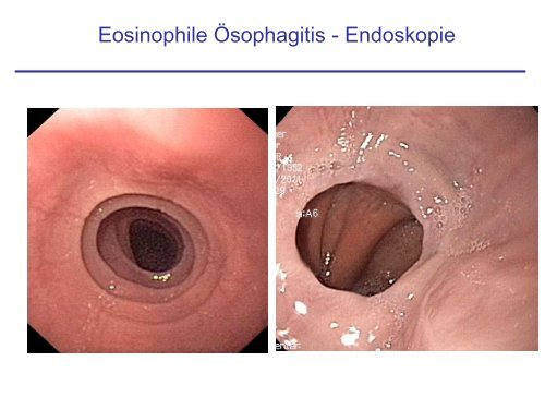 Eosinophile Ösophagitis