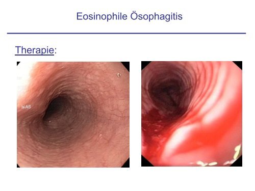Eosinophile Ösophagitis