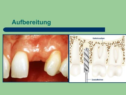 Implantat Prophylaxe