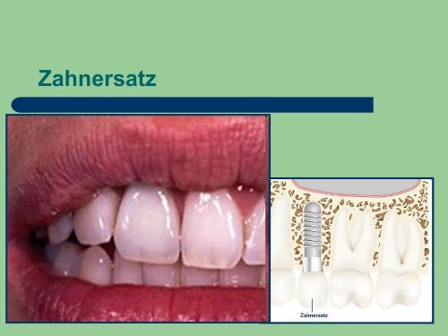 Implantat Prophylaxe