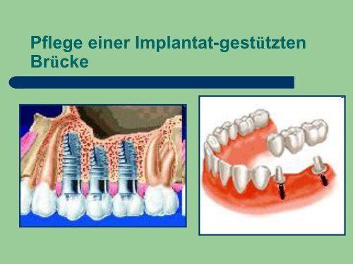 Implantat Prophylaxe