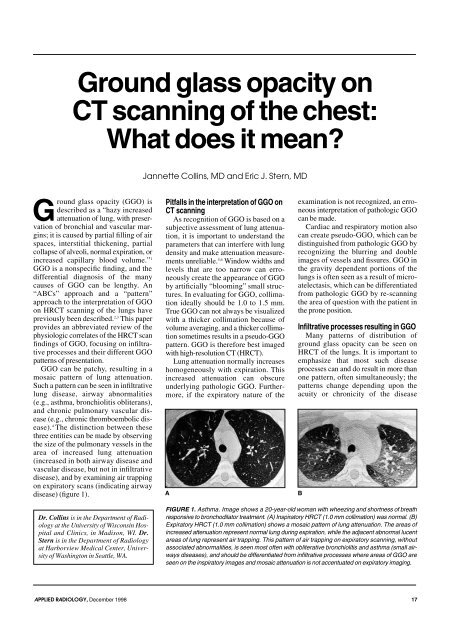 Ground glass opacity on CT scanning of the chest: What does it mean?