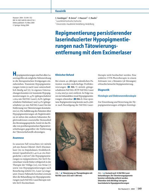 Repigmentierung persistierender laserinduzierter Hypopigmentie ...