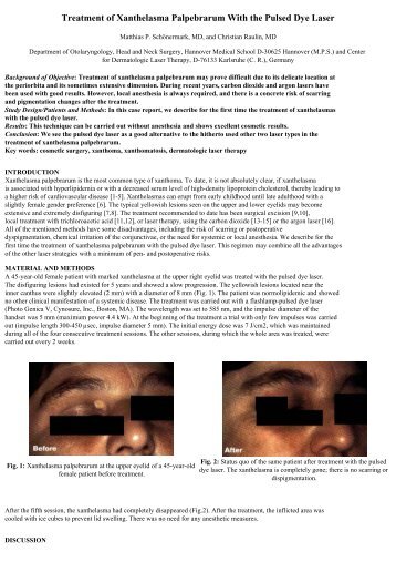 Treatment of Xanthelasma Palpebrarum With the Pulsed Dye Laser