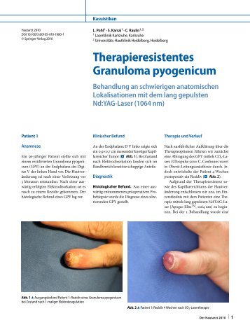 Therapieresistentes Granuloma pyogenicum - Laserklinik Karlsruhe