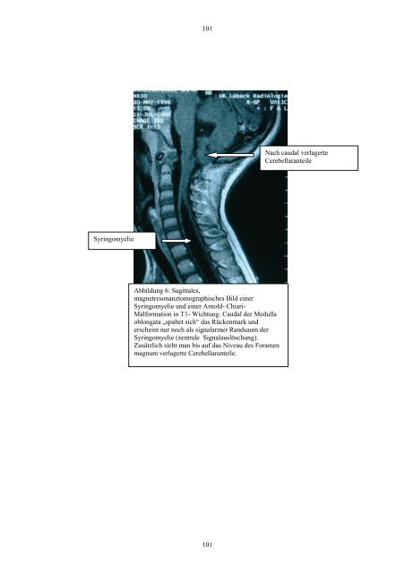 Klinische Symptomatik des Tethered Cord Syndroms bei Spina ...