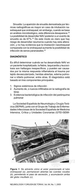 Neumonía asociada a ventilación mecánica - edigraphic.com