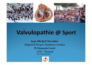 valvulopathie et sport - Club des Cardiologues du Sport