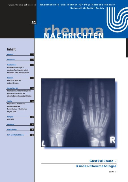 Symptome der Arthrose - Osteoarthritis - IBSA Switzerland