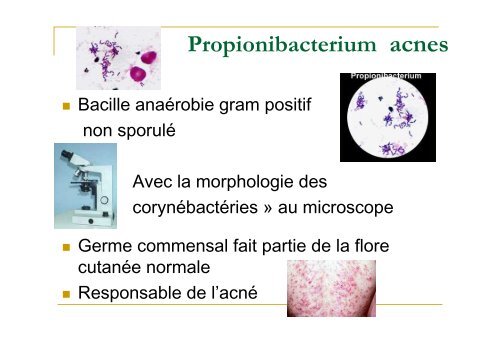 Un germe émergent - P acnes - ARLIN de Lorraine