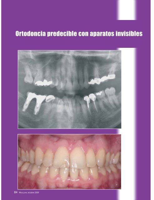 Ortodoncia predecible con aparatos invisibles - Menendez ...