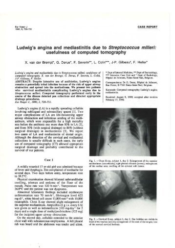 Ludwig's angina and mediastinitis due to Streptococcus milleri ...