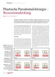 Plastische Parodontalchirurgie – Rezessionsdeckung