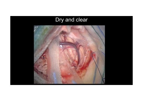 Intraoperative Hemostasis in Neurosurgery