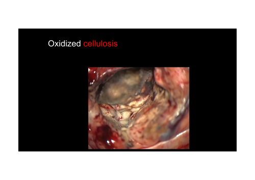 Intraoperative Hemostasis in Neurosurgery