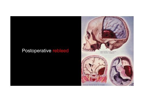 Intraoperative Hemostasis in Neurosurgery