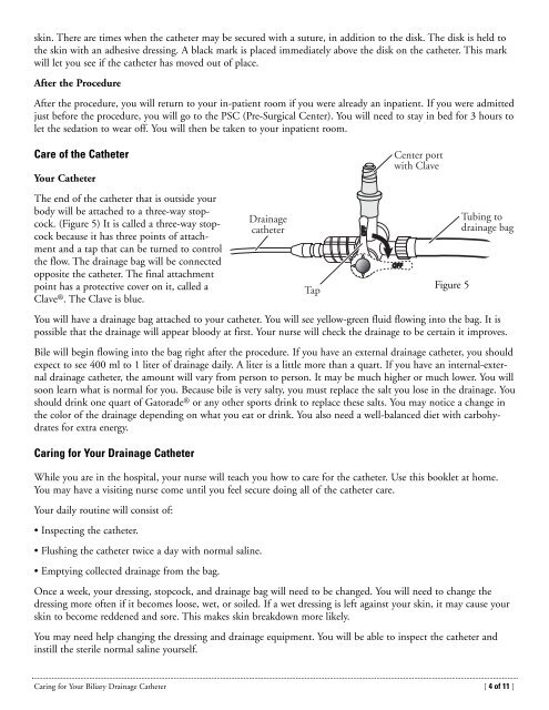 Caring for Your Biliary Drainage Catheter - Memorial Sloan ...