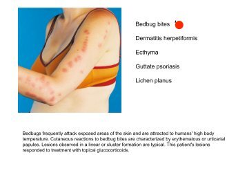Bedbug bites Dermatitis herpetiformis Ecthyma Guttate ... - MDC
