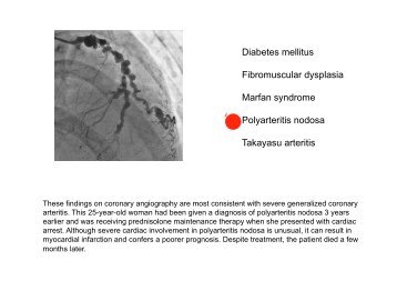 Diabetes mellitus Fibromuscular dysplasia Marfan syndrome ... - MDC