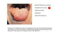 Beckwith-Wiedemann syndrome Hypoglossal nerve injury ... - MDC