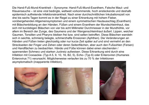 Beckwith-Wiedemann syndrome Hypoglossal nerve injury ... - MDC