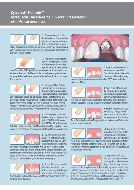 die Cytoplast-Broschüre (PDF, 950kb) - MDS-Dental