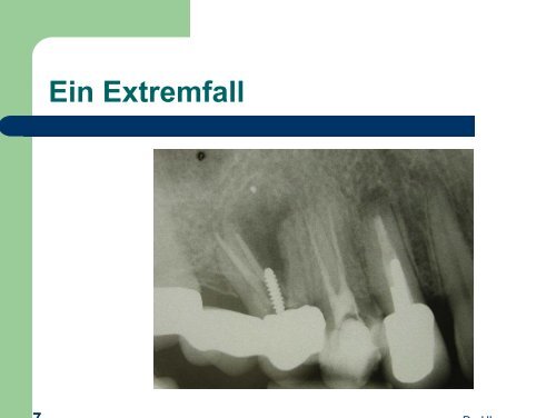 Dentinadhäsive Stumpfaufbauten oder  adhäsive ... - MDS-Dental