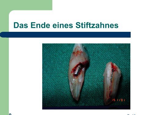 Dentinadhäsive Stumpfaufbauten oder  adhäsive ... - MDS-Dental