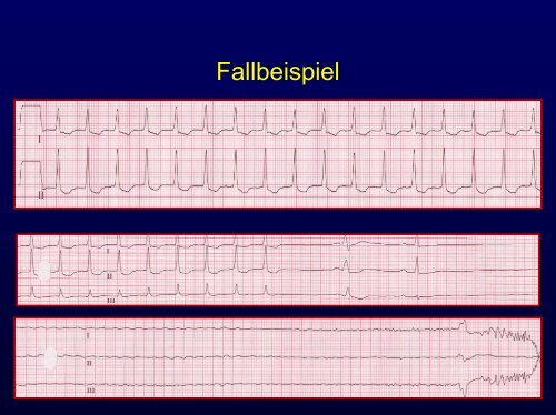 Bradykarde HerzrhythmusstÃ¶rungen