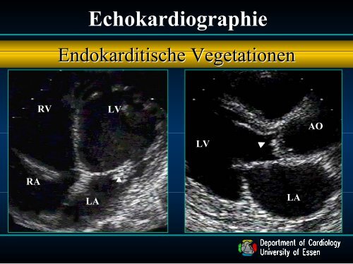 4. Vortrag Endokarditis - Dr. med. C. Naber (ca