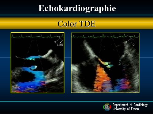 4. Vortrag Endokarditis - Dr. med. C. Naber (ca