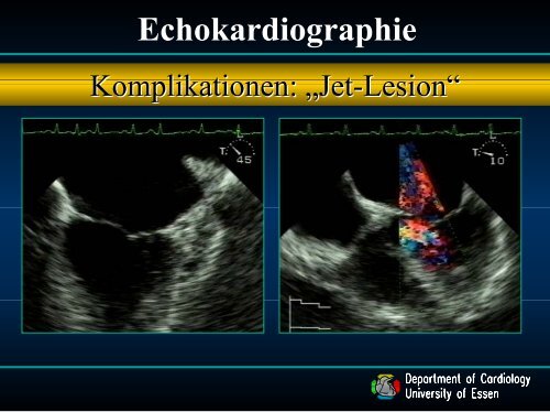 4. Vortrag Endokarditis - Dr. med. C. Naber (ca