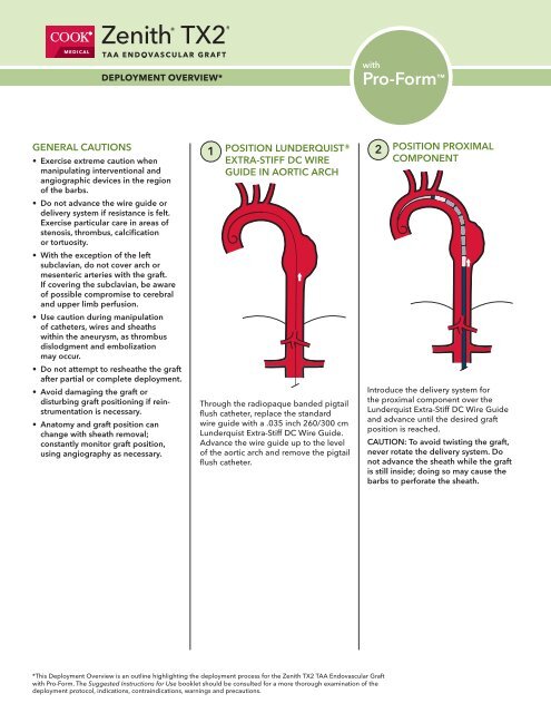 Zenith TX2 with Pro-Form TAA Endovascular Graft - Cook Medical