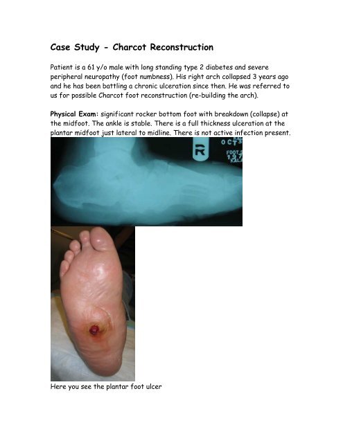 Case Study - Charcot Reconstruction