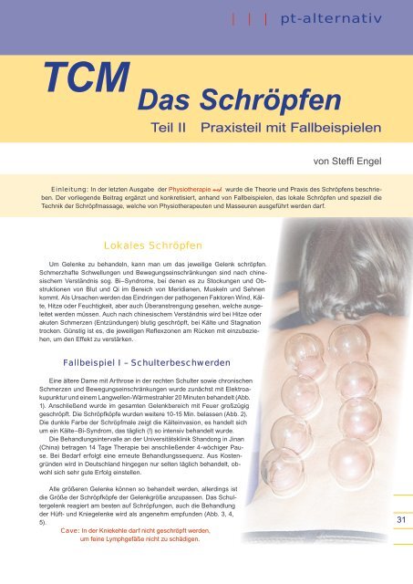 Das Schröpfen - Naturheilpraxis Steffi Engel, Heilpraktikerin