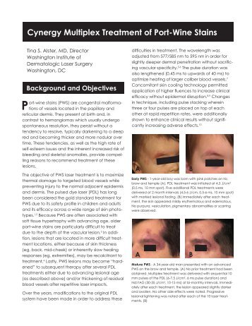 Cynergy Multiplex Treatment of Port-Wine Stains