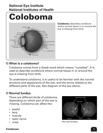 Coloboma - National Eye Institute - National Institutes of Health