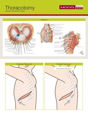 Thoracotomy Catheter Placement Guide - Moog Inc