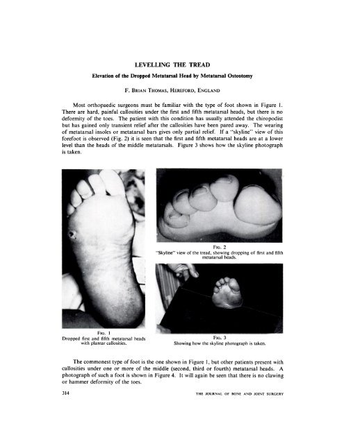 Fallen metatarsal deals arch